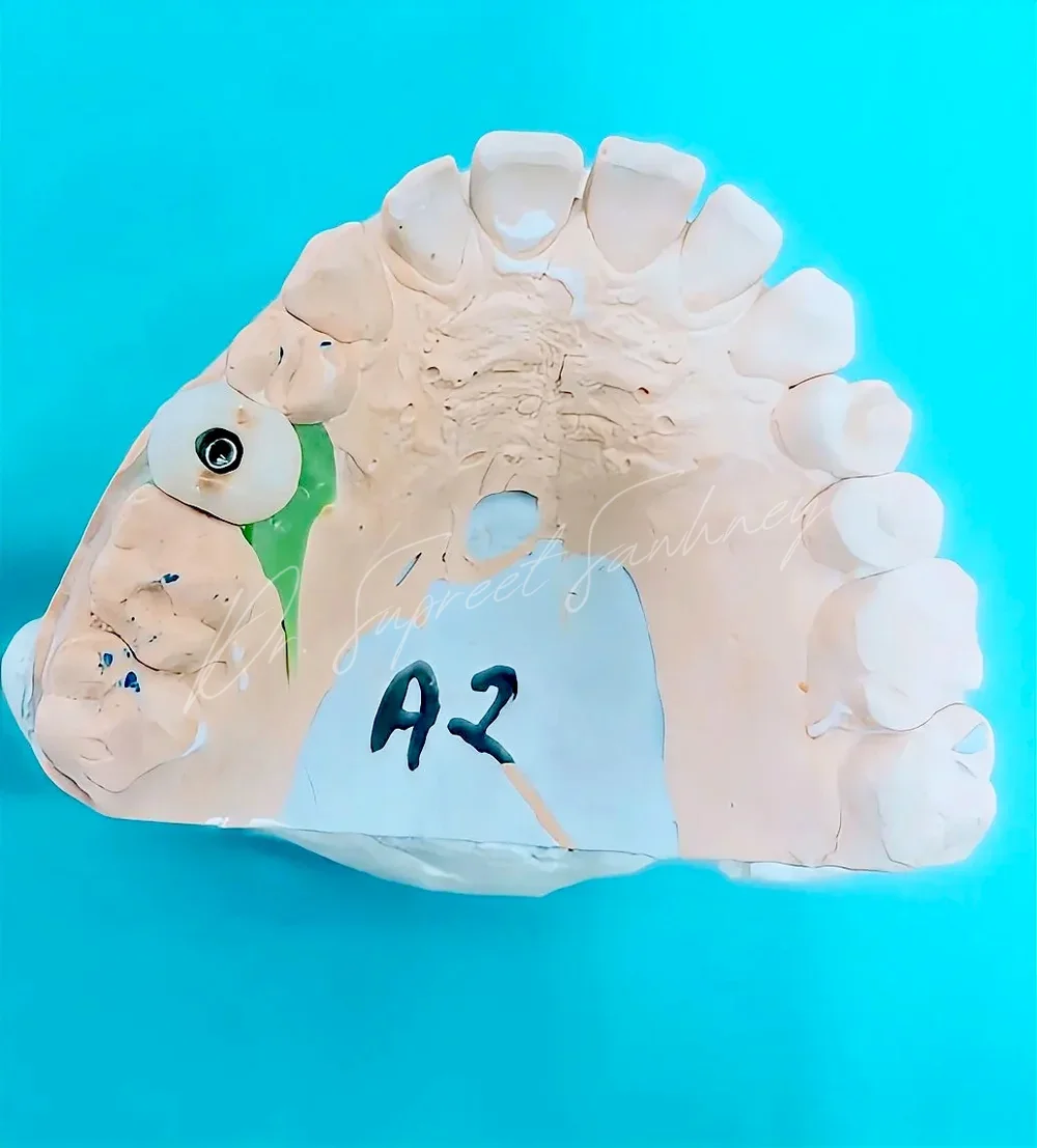 Maxillary working cast with an implant analog at a posterior tooth position
